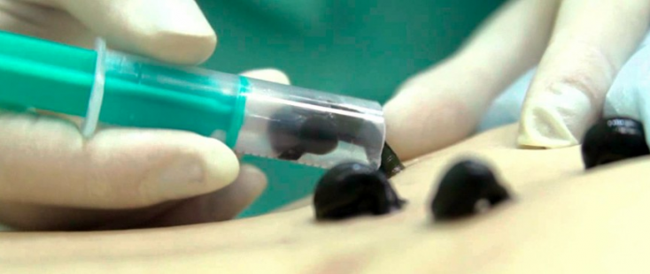 gematoma 1