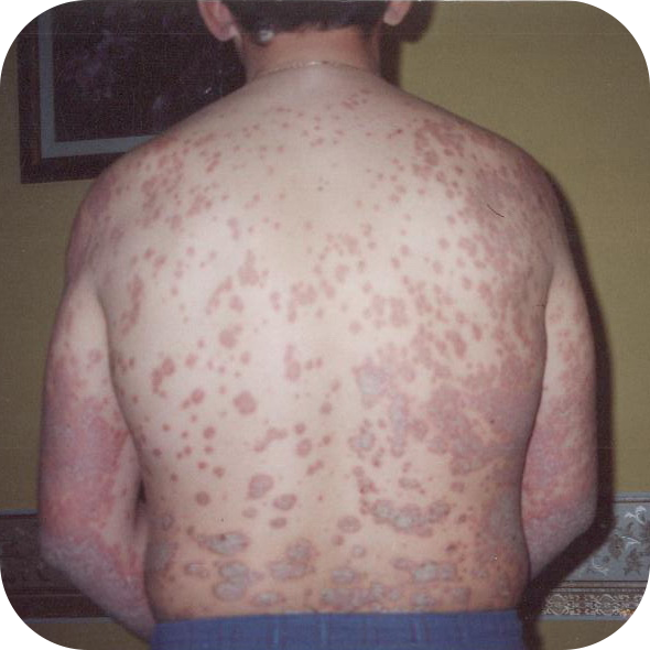 likuvanna psoriazu 1