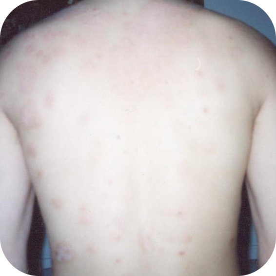 likuvanna psoriazu 2